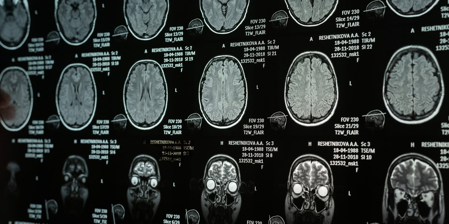 Puberty, pregnancy, and menopause are accompanied by distinct patterns of brain plasticity