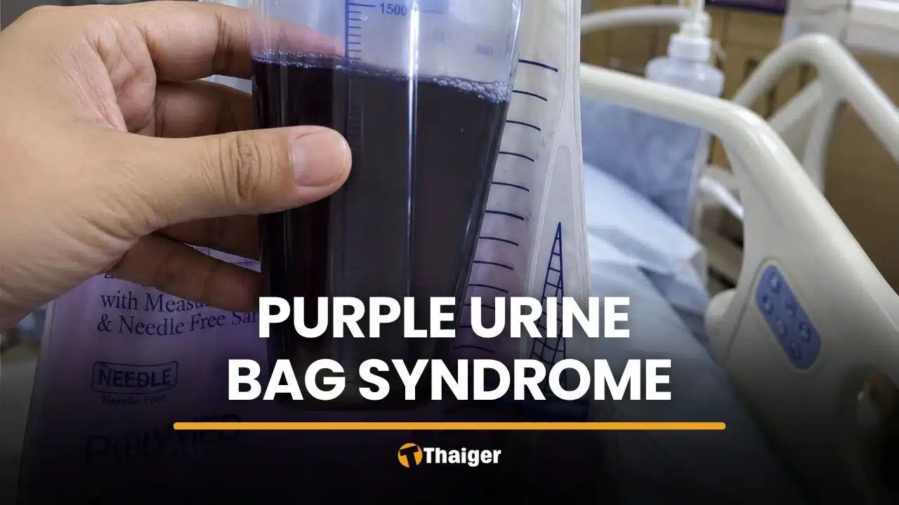 Purple urine signals hidden infection, not drugs, in Thai man