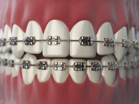 Braces beyond treatment: Gen Z’s fashion craze and the hidden dental risks