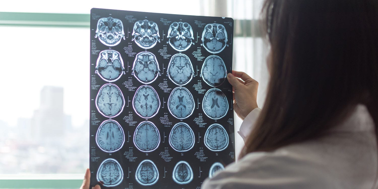 Migraines are linked to accelerated brain aging in regions tied to memory and emotion