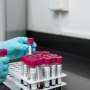 Activated donor immune cells may prevent severe complication after allogeneic stem cell transplantation