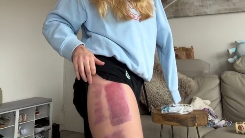 'Devastated' shark attack survivor said skin graft has failed