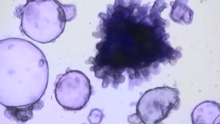 Hopes 'mini guts' will help researchers treat inflammatory bowel disease