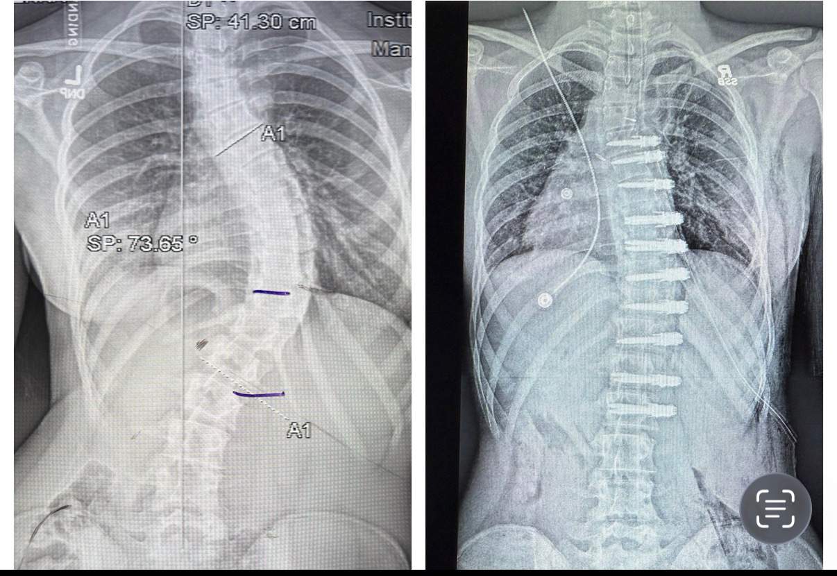 Alberta teen’s family sues government after nearly $200K out-of-country surgical bill