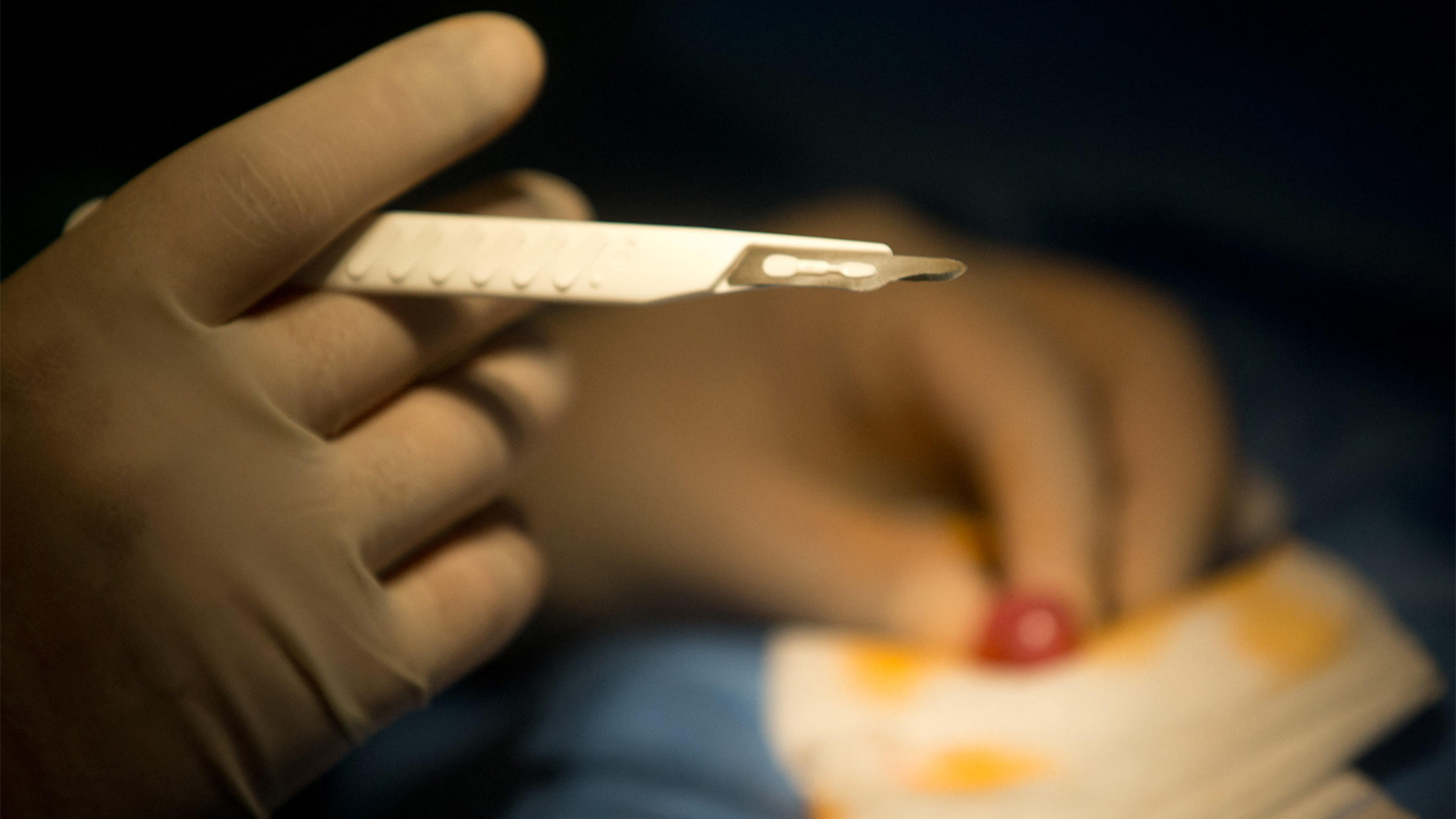 Circumcision and Autism: What a New Study Found